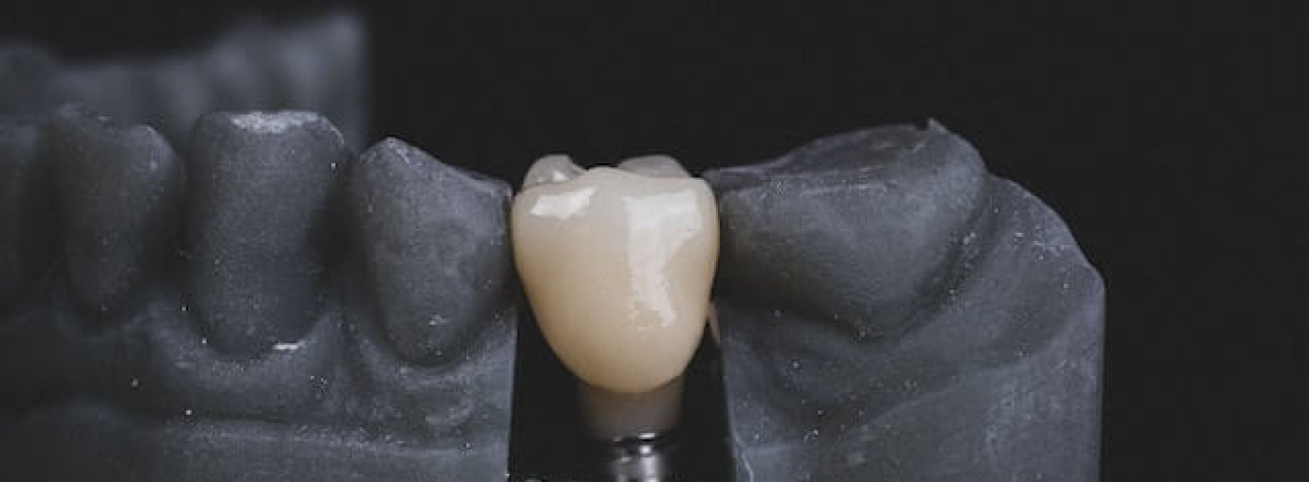 Implanty zębowe w różnych grupach wiekowych