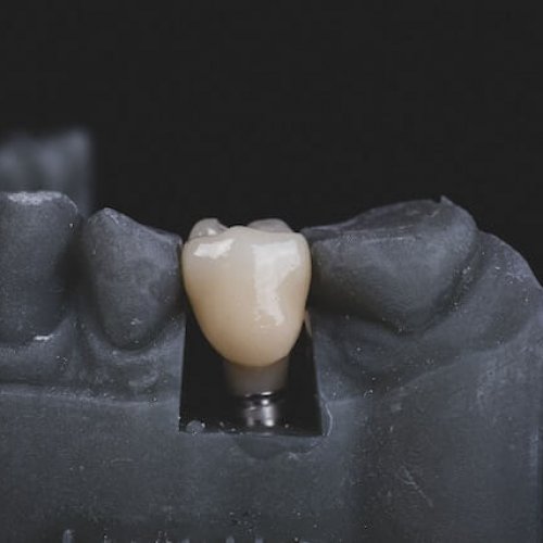 Implanty zębowe w różnych grupach wiekowych